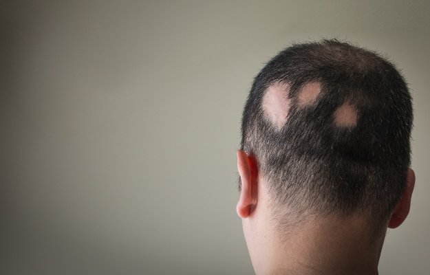 Alopecia-Aerata | Telogen Effluvium: A Closer Look at Stress Related Hair Loss