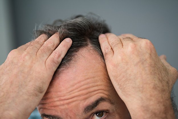 Man-Checking-His-Hair-Loss-And-Dandruff-Hair-Loss-ss-body | 12 Signs That You Need a Testosterone Test