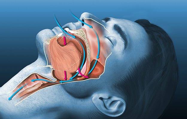 Sleep apnea and snoring problem | What Causes Sleep Apnea and How to Prevent It