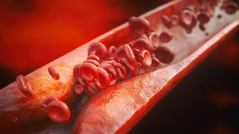 Atherosclerosis vs Arteriosclerosis