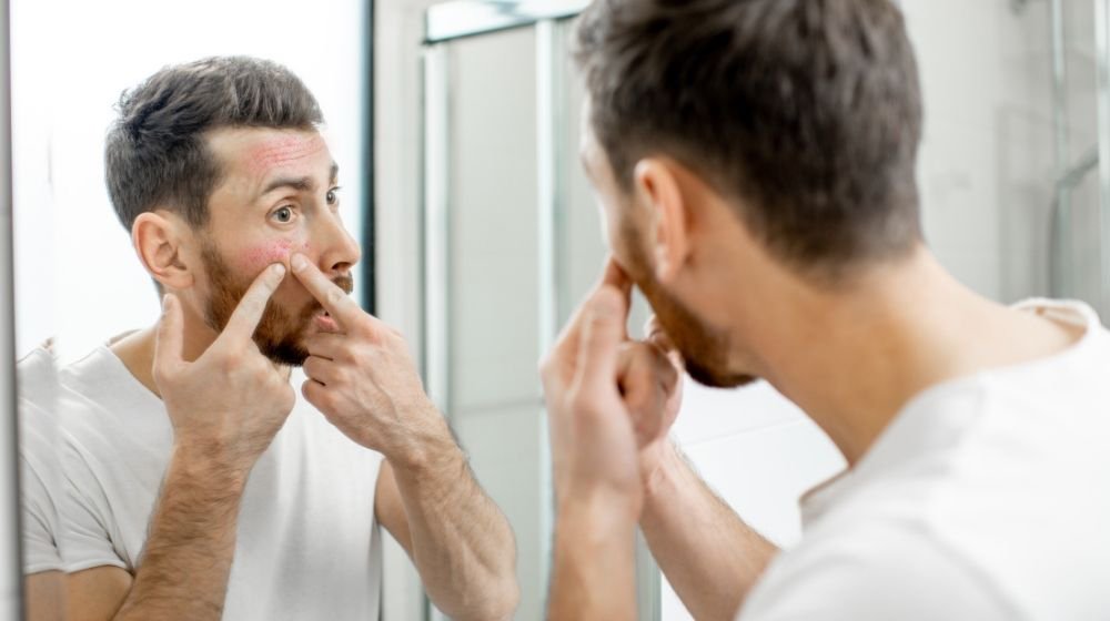 Adult Acne in Men: Causes and Treatments