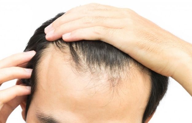 Middle aged man with hair loss problem