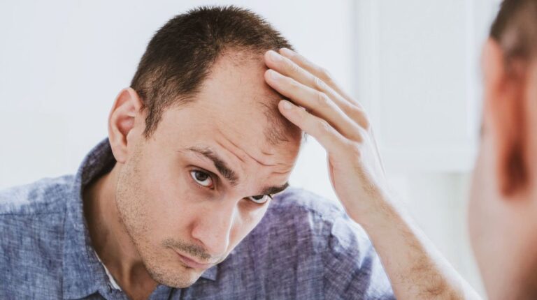 Male pattern hair loss problem concept. Young caucasian man looking at mirror worried about balding. Baldness, alopecia in males | Feature | Why Is My Hair Falling Out? Hair Loss Causes & Treatments